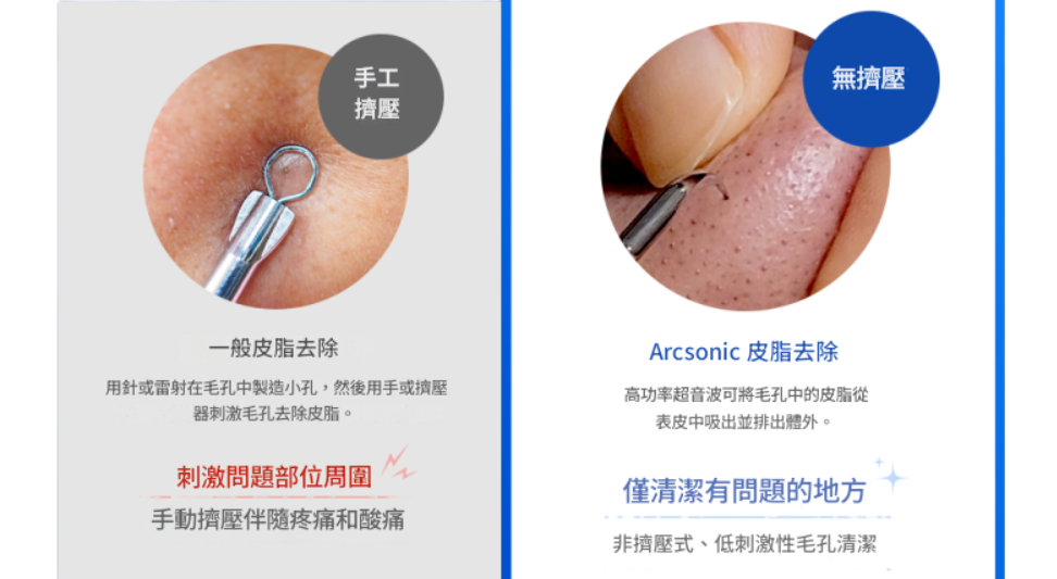 韓國🇰🇷 Arcsonic無創超聲波清黑頭機 4頭
