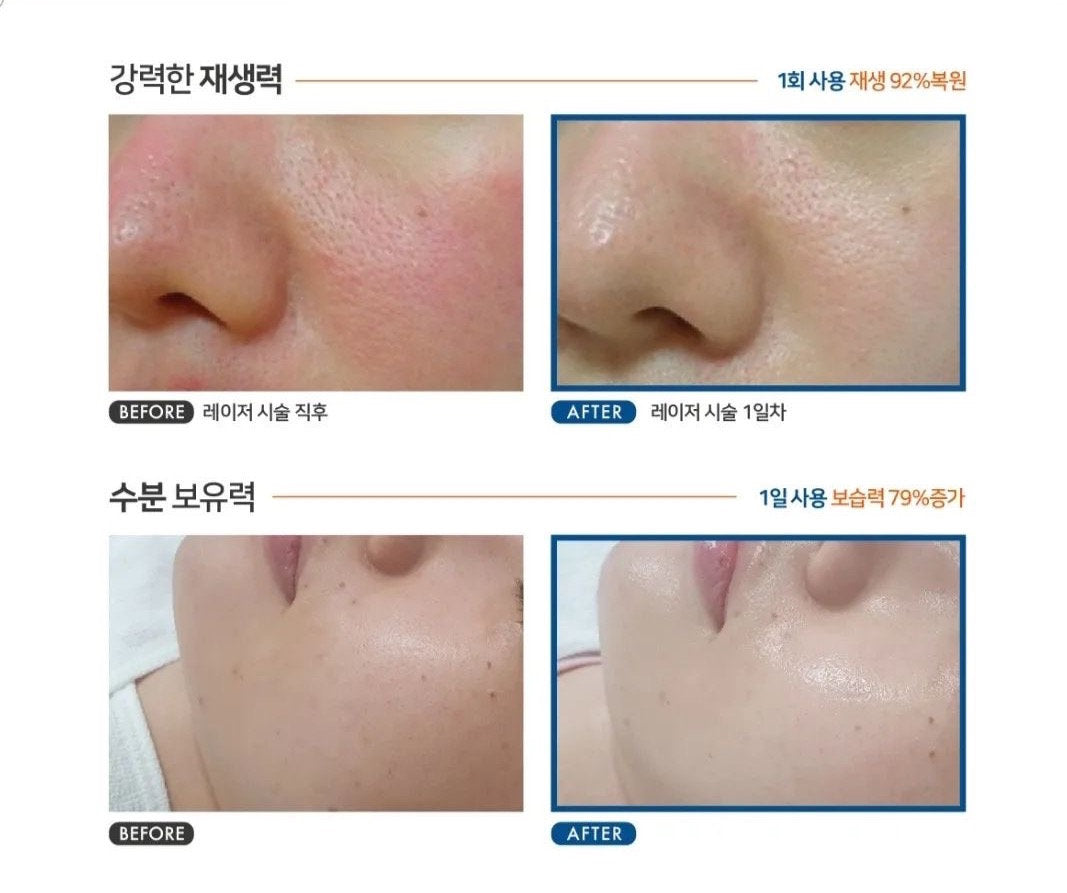 韓國CELLDICH Tox Co2 KIT注氧再生套盒  6次/盒