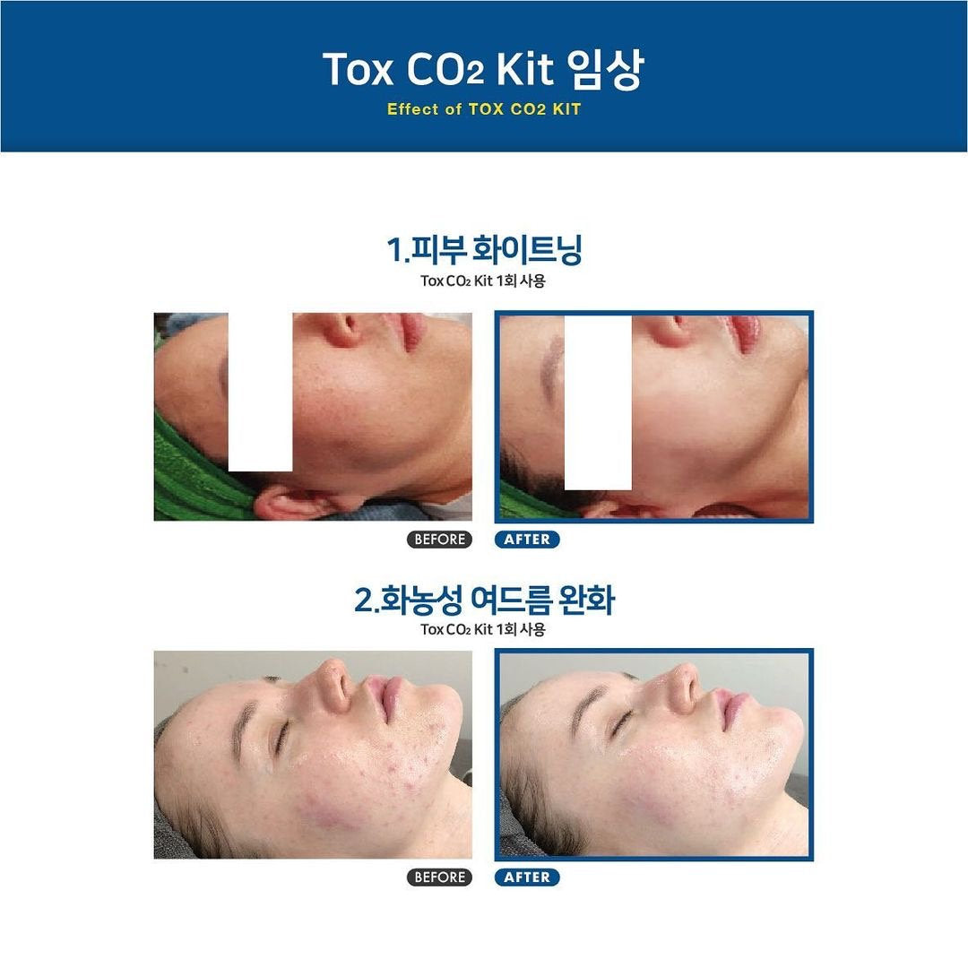 韓國CELLDICH Tox Co2 KIT注氧再生套盒  6次/盒