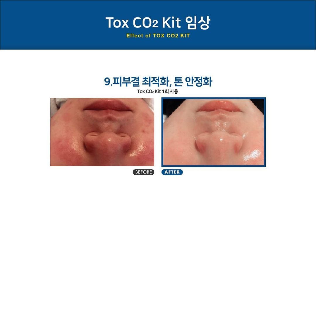 韓國CELLDICH Tox Co2 KIT注氧再生套盒  6次/盒