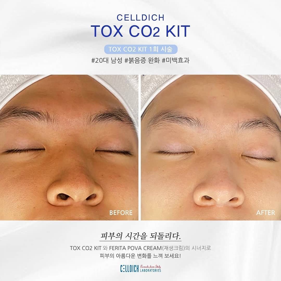 韓國CELLDICH Tox Co2 KIT注氧再生套盒  6次/盒