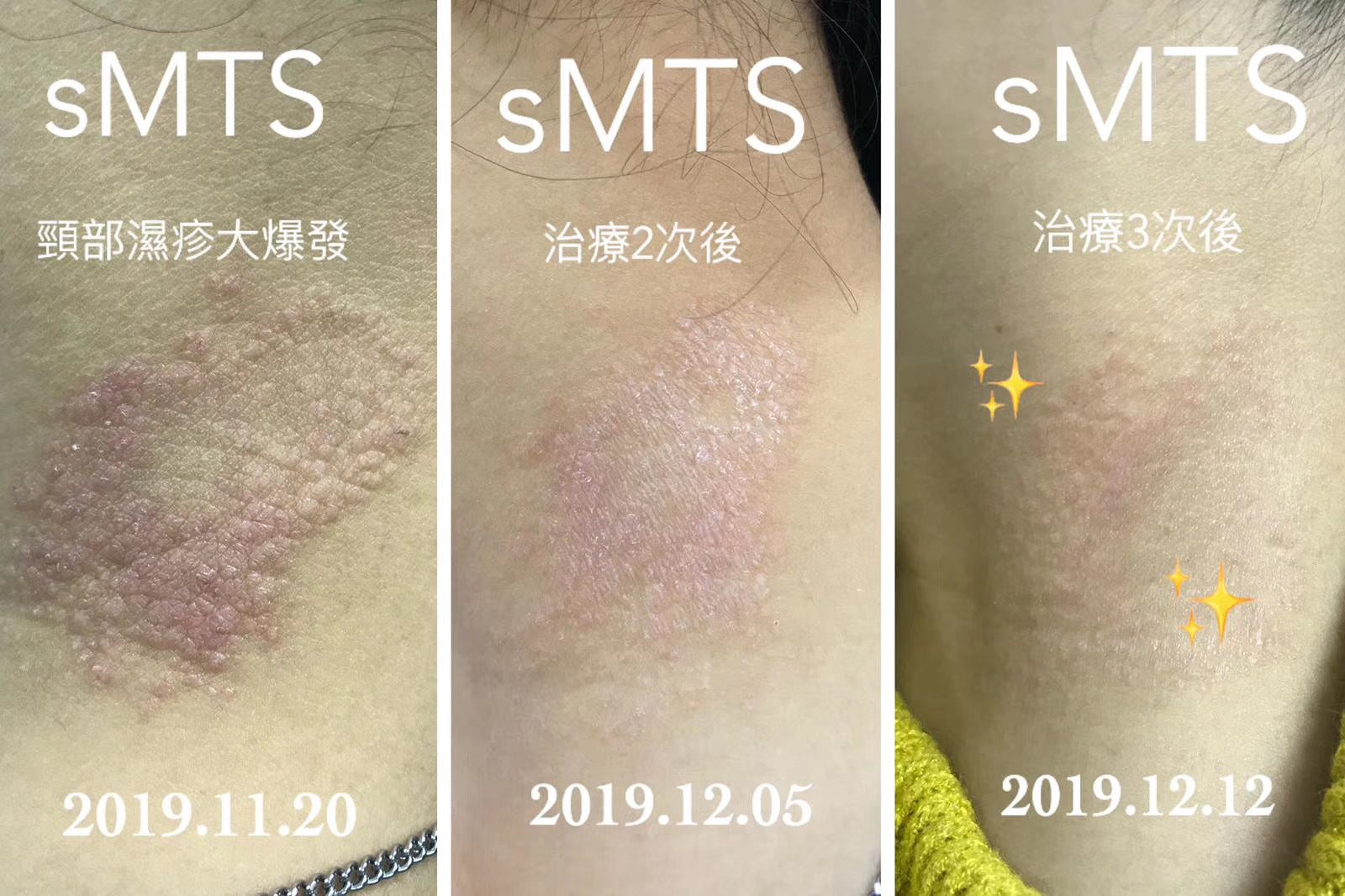 韓國SMTS 幹細胞嬰兒針療程-美容療程預約