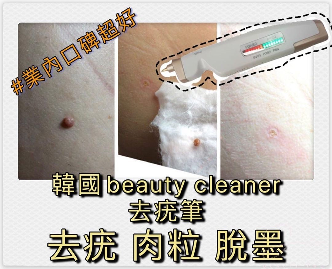 新款 韓國beauty Cleanser spotless氣化脫疣筆（可脫墨）