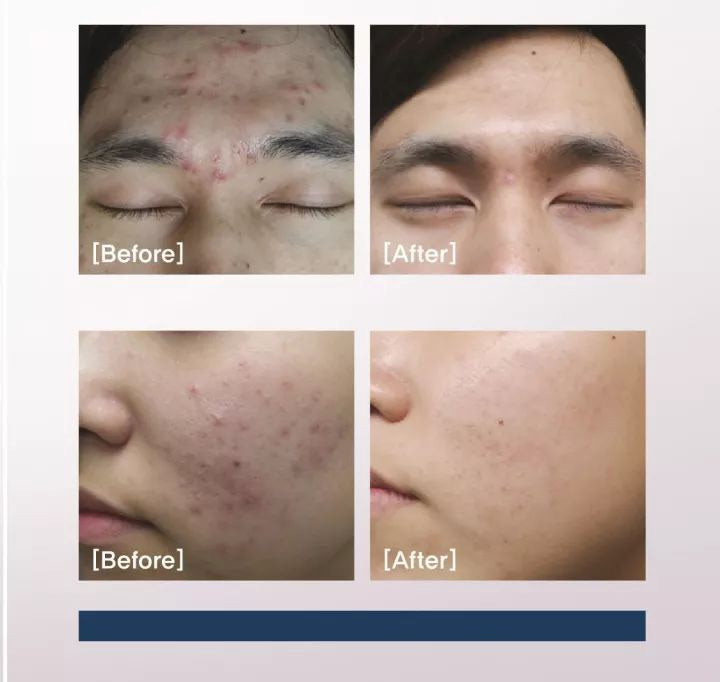 韓國陶瓷肌系列-  Foxc peel 女神煥膚美容院裝 50次