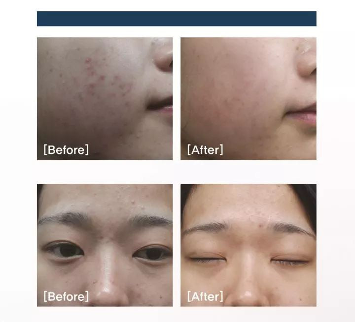 韓國陶瓷肌系列-  Foxc peel 女神煥膚美容院裝 50次